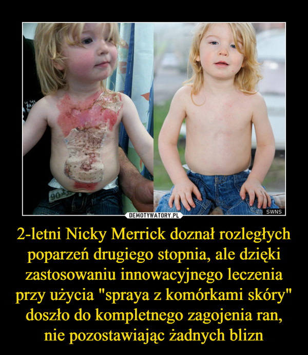 2-letni Nicky Merrick doznał rozległych poparzeń drugiego stopnia, ale dzięki zastosowaniu innowacyjnego leczenia przy użycia "spraya z komórkami skóry" doszło do kompletnego zagojenia ran, nie pozostawiając żadnych blizn –  