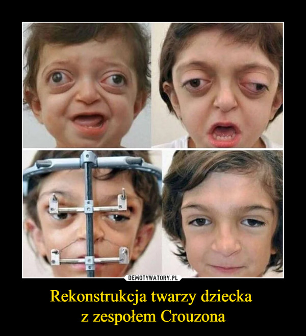 Rekonstrukcja twarzy dziecka z zespołem Crouzona –  