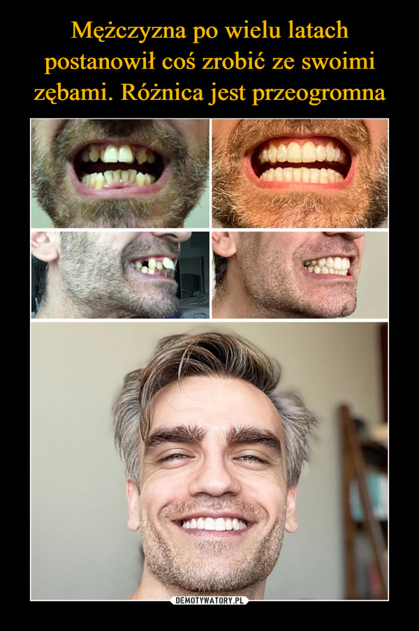 Mężczyzna po wielu latach postanowił coś zrobić ze swoimi zębami. Różnica jest przeogromna
